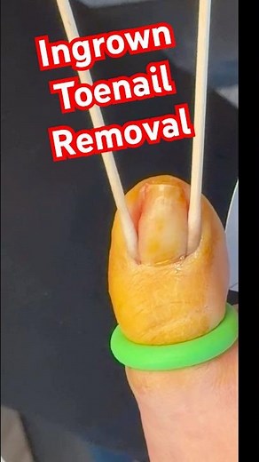 Ingrown Toenail Removal