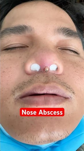 This Nose Pimple Turned Into a Serious Abscess #NosePimple #Abscess #shorts