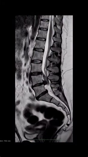 Physio.noww on Instagram: "A herniated disc occurs when the inner material of the disc bulges out and can compress a nerve root, causing pain or limited movement. In milder cases, it’s called a protrusion, where the disc simply bulges without rupturing. Proper diagnosis allows for choosing the best treatment for each patient . . . . . #Neurosurgery #Spine #HerniatedDisc SpinalHealth . Reference :- @neuroarevir"