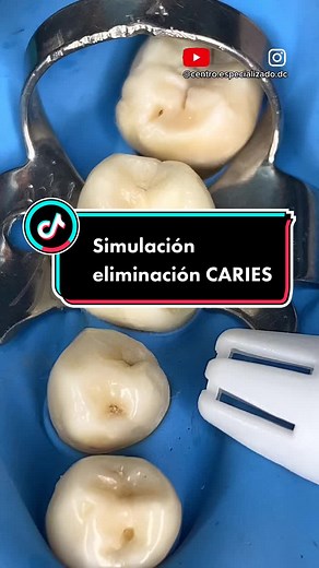 Tooth Extraction Process - Dental Procedure Explained