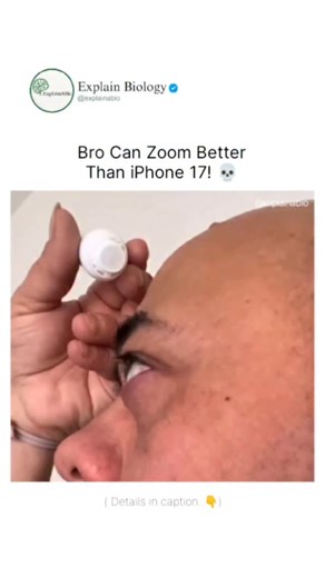 BIOLOGY | MEDICAL | LIFE on Instagram: "This man appears to show a rare eye condition that causes the eyes to bulge outward — a symptom commonly seen in certain thyroid-related disorders. In such conditions, tissues around the eyes can swell, leading to prominent exophthalmos. Only a medical professional can confirm the exact diagnosis, but symptoms like this can affect vision, comfort, and long-term eye health, making proper evaluation and treatment very important. Follow us @explainabio for mo