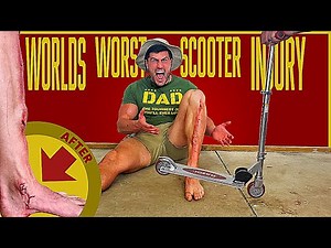 Creating the WORST SCOOTER INJURY of all Time | Bodybuilder VS The Worst Pain Ever Experiment