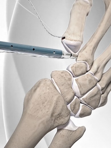 Finger Fracture Surgery Explained: Recovery Insights