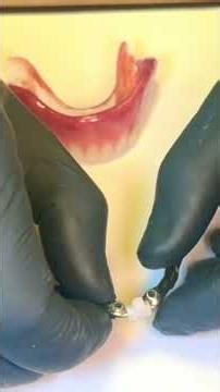 Removable prosthesis with and without implant: learn the details