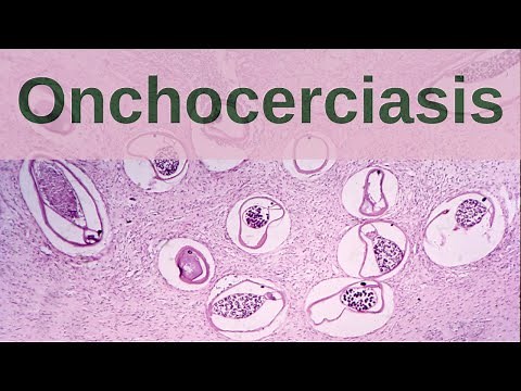 What is Onchocerciasis? - Pathology mini tutorial