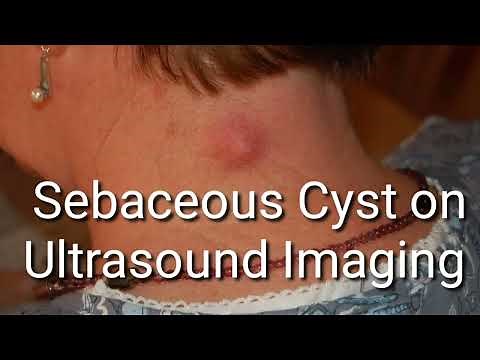 Ultrasound video Reveals Detailed Look Inside a Sebaceous Cyst