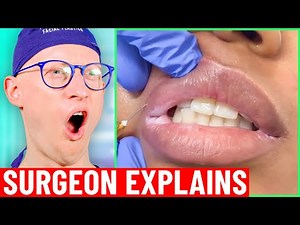 Lip Filler Dissolving