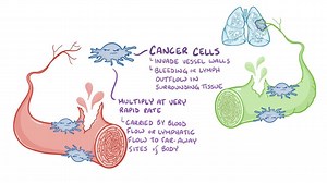 Video: Angiosarcomas - Video Explanation! | Osmosis | Osmosis