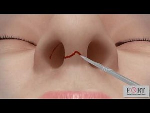 RHINOPLASTY - Nose Correction - Fort Hospital -nose plastic surgery cost
