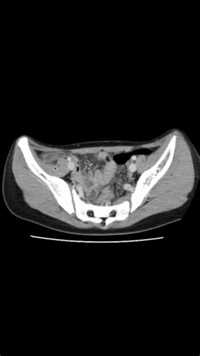 If you have appendicitis, large swelling on a CT scan. #Appendicitis #CT #Imaging diagnosis