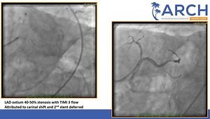 Left Main PCI: Techniques and Case Examples