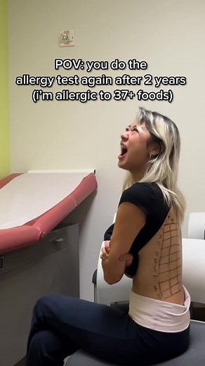 Understanding Food Allergies: My Recent Experience