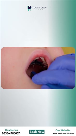 Anterior crossbite orthodontic treatment explained #dentist #dentaltreatment