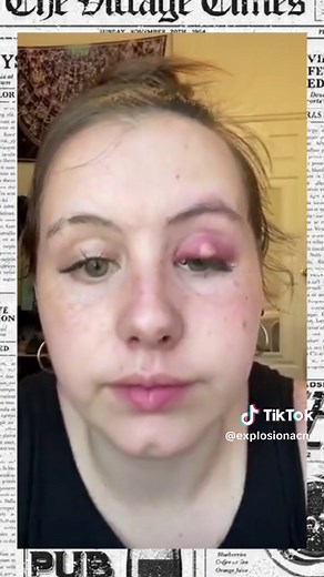 Explosion Acne no TikTok