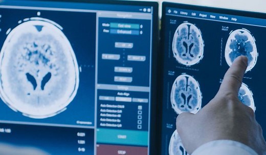 La leucopathie vasculaire, une lésion banale au niveau du cerveau