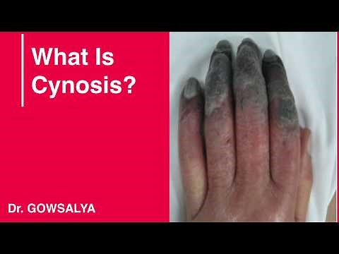 What is Cyanosis
