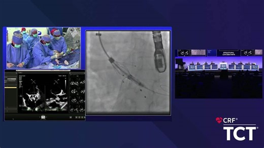 Live Case Transcatheter Aortic Valve Replacement for Aortic Regurgitation-