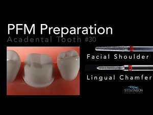 PFM Preparation - Acadental Tooth #30 | Dr. Richard Stevenson