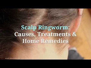 Scalp Ringworm : Causes, Symptoms And Treatment