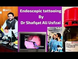 Effective Endoscopic Tattooing. Colonoscopy. SRUS tattooing for surgery. Modern gastroenterology.