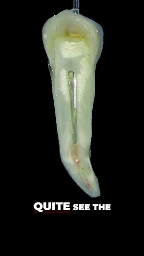 Dentist's Layered GP Technique Easy Root Canal Filling!