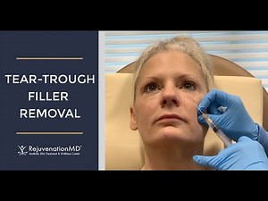 Tear-Trough Filler Removal