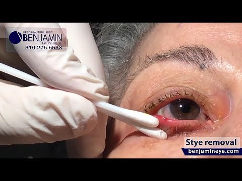 A quick and effective Stye removal in-office procedure