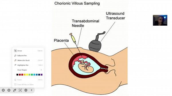Chorionic Villus Sampling CVS ; sample of placental tissue called chorionic villi