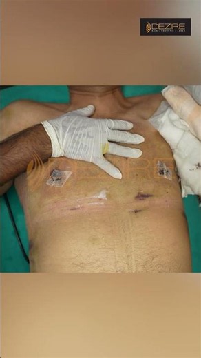 Gynecomastia Surgery Dressing