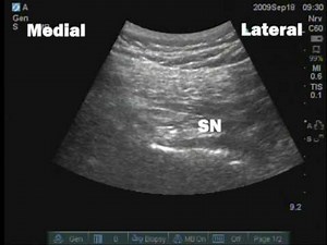 Unintentional sciatic nerve block following pudendal nerve block
