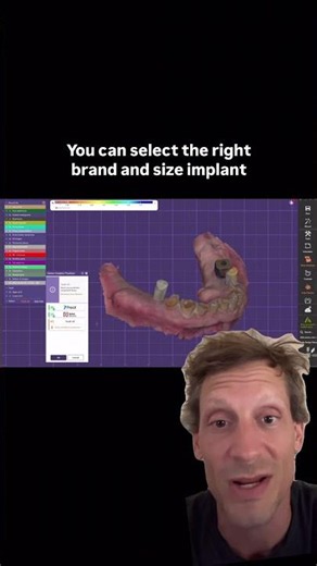 Correcting The Implant In Exocad #3dprinting #exocad