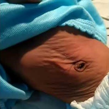 Delayed Skin Pinch Test - Sign of Dehydration - Skin Turgor