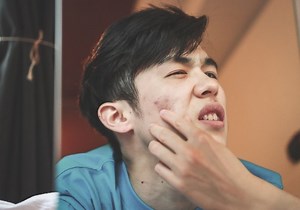 What are Demodex Mites and Why Do They Live in My Skin and Hair Follicles?