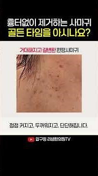 Do you know the golden time to remove flat warts without scarring?