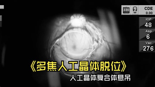 【多焦点人工晶体脱位】Dislocated Multifocal Lens Implant on the Retina Suture Repositioning