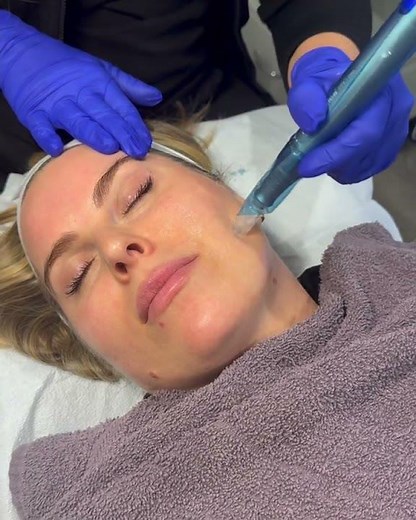 Nano Infusion Microneedling