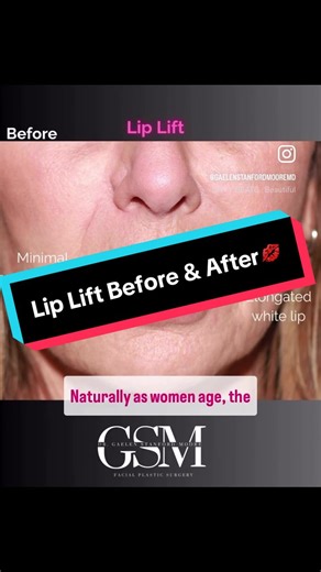 ✨ Achieve a naturally youthful pout with a surgical lip lift! ✨ This safe, straightforward procedure is performed under local anesthesia and offers long-lasting enhancement by shortening the distance between the nose and upper lip — creating a fuller, lifted appearance without filler. 💋⁠ ⁠ A lip lift is ideal for patients looking to restore youthful proportions and definition to the mouth area. Minimal downtime, maximum results. 💉🕊️ 📍Book your consultation today and discover if a lip lift is