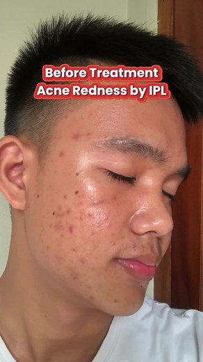 IPL Acne Treatment at Dermies Max: Before and After Glow Up