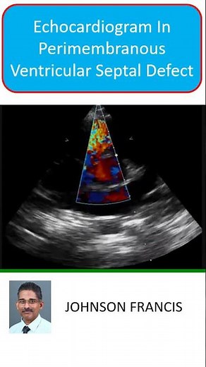Echocardiogram In Perimembranous VSD