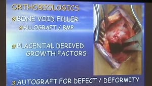 Anatomic Compression Arthrodesis Technique With and Anterior Plate Augmentation for Ankle Arthrodesis