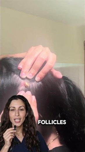 Why Popping This Can Cause Bald Spots