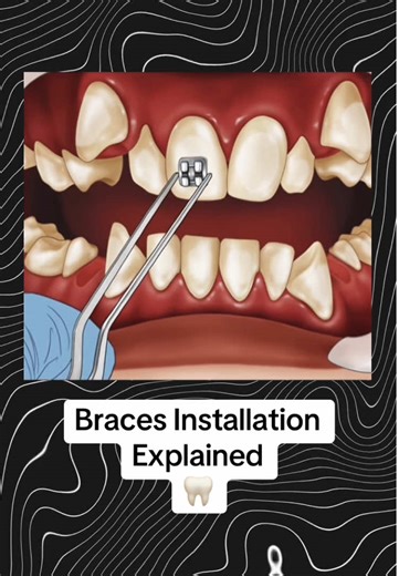 Braces Installation Explained: A Comprehensive Guide