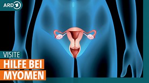 In den meisten Fällen ist ein Myom harmlos, doch manchmal verursacht ein Uterus Myomatosus heftige Symptome. Wie entstehen Myome, wann ist eine Entfernung sinnvoll und welches Operationsverfahren schont die Gebärmutter? | ARD GESUND