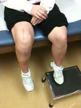 Fulkerson Osteotomy & Proximal Realignment Procedure - Dr. Tony Jabbour