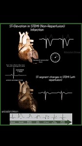 772 reactions · 6 comments | ST-Segment Evolution in STEMI: Reperfusion vs. Non-Reperfusion. Temporal Evolution of ST-Segment and Q Waves in STEMI: Impact of Reperfusion Therapy. #Cardiology #ECG #STEMI #CardiacMRI | Abdallah Othman | Facebook