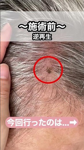 【頭皮のイボ除去】ストレスだったイボをメスを使わずに綺麗さっぱりに！