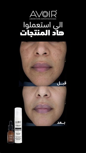 علاج البقع الداكنة والكلف منصوح به من طرف خبراء الجلد 🔥 ‎الطلب عبر الواتساب: 0660756518