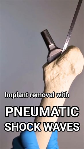 Implant removal for hip, shoulders, knees using pneumatic shock waves #orthopaedicsurgery #surgery