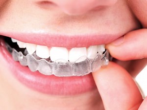 Invisalign Comprehensive: precio, opiniones del tratamiento y más