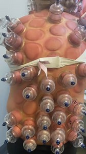 1.9M views · 430 reactions |  Cupping lifts the skin and fascia to release deep muscle tension, improve circulation, and support faster recovery. Perfect for tight traps, sore legs, or post-leg day stiffness. ‍♀️‍♂️‍♀️#CuppingTherapy #MuscleRecovery #FascialRelease #PainRelief #ChicagoChiropractor #DrKyleRoss | Dr_kyleross | Facebook